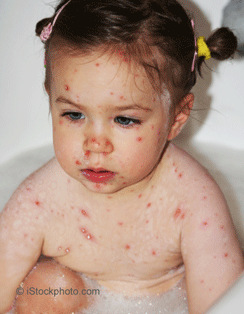 child with chickenpox
